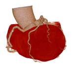 心臓に血液を送る血管（冠動脈）画像例