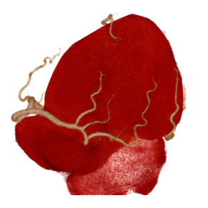 心臓に血液を送る血管（冠動脈）画像例