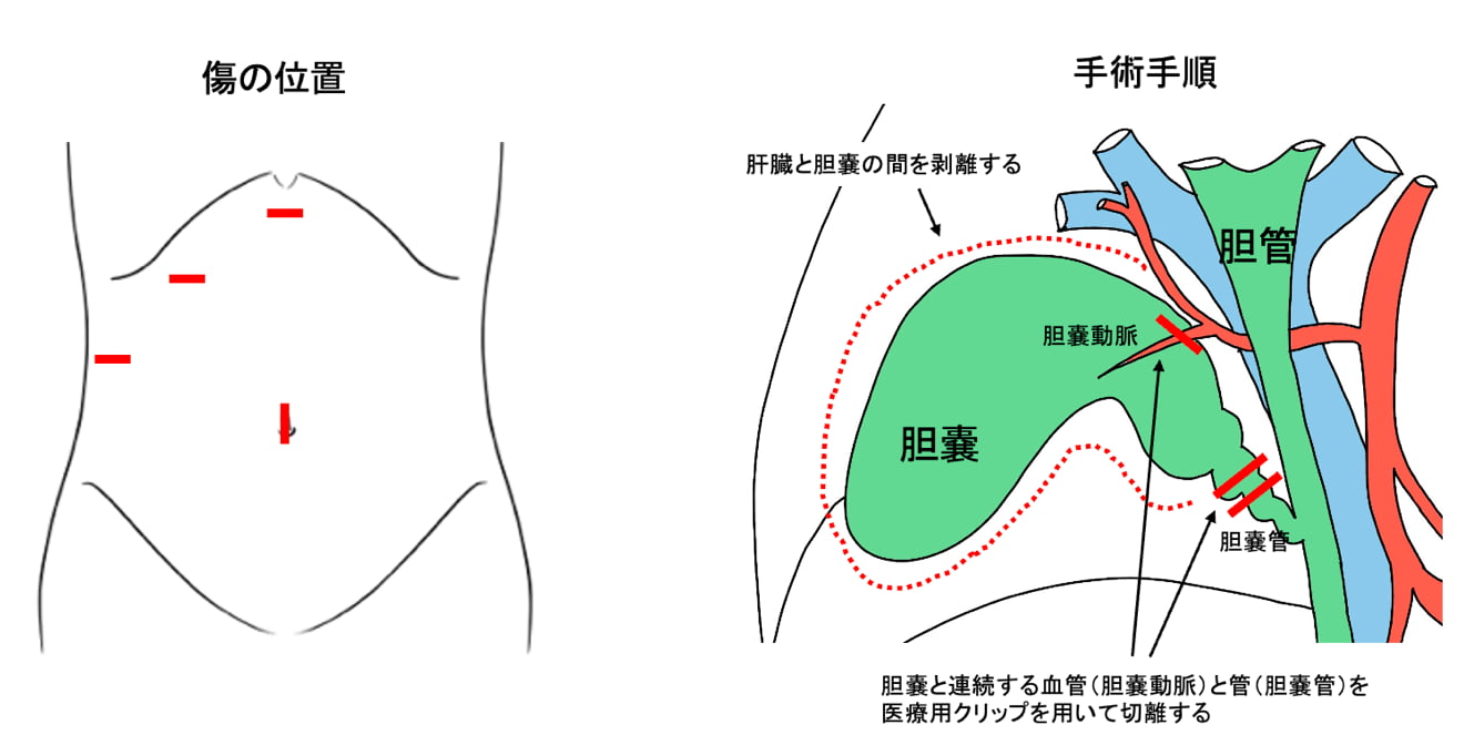 腹腔鏡下胆嚢摘出の準備はどのようにすればよいですか?