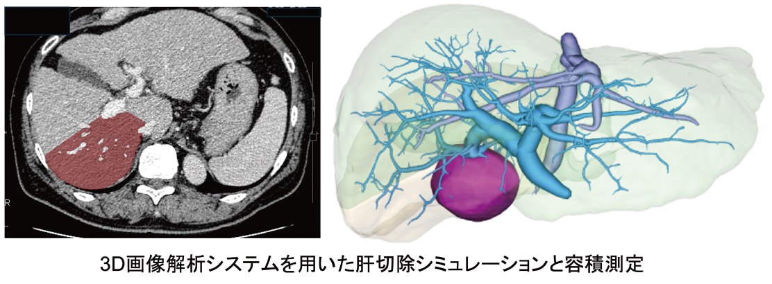 3D画像解析システムを用いた肝切除シミュレーションと容積測定