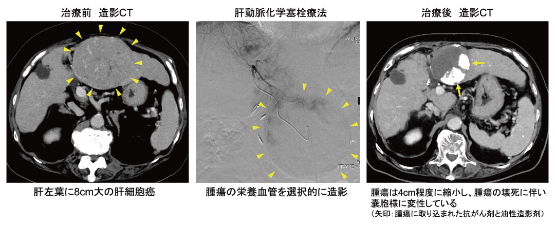 肝細胞癌に対する肝動脈化学塞栓療法