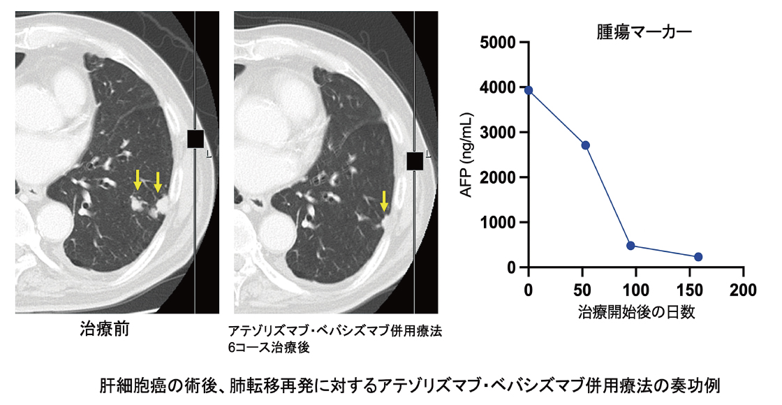 アテゾリズマブ・ベバシズマブ併用療法の奏功例