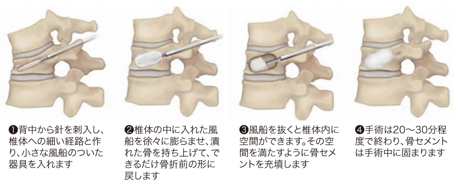 BKP（経皮的椎体形成術）について