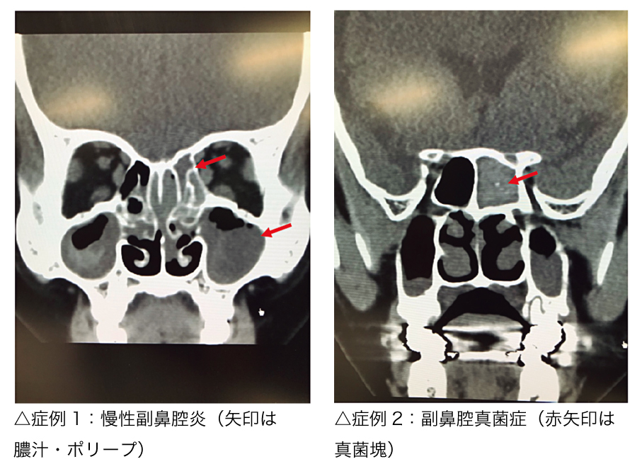 鼻副鼻腔手術症例1,2