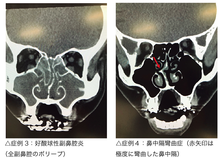 鼻副鼻腔手術症例3,4