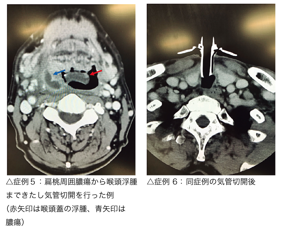 口蓋扁桃摘出術