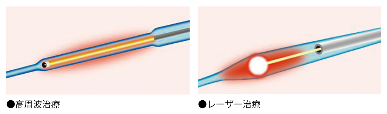 血管内焼灼治療